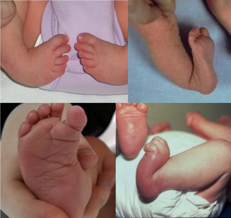Piciorul stramb congenital al bebelusilor