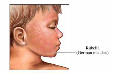 Rubeola (Pojarel, rubella, baranyi himlo) - Boli infectioase