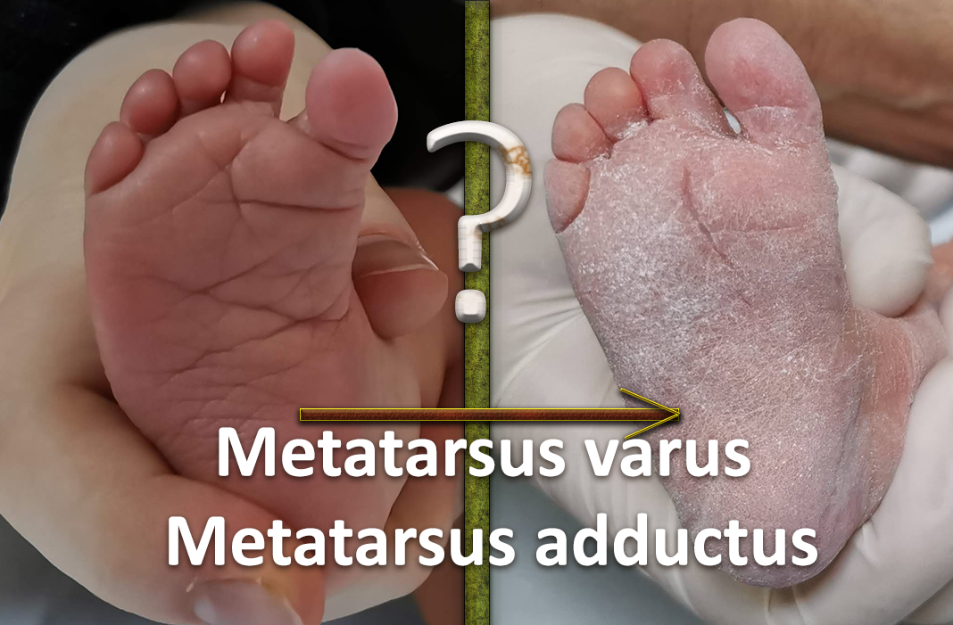 Metatarsus Adductus - Metatarsus Varus