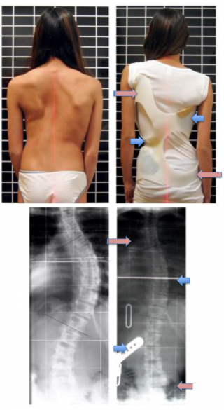 Pacient aflat in tratament ortopedic cu Corset Cheneau. Evolutie clinica si radiologica.