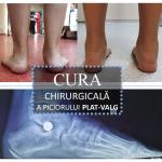 Artroerezis - tratamentul chirurgical minim invaziv al piciorului plat-valg