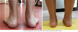 picior plat valg flexibil - inainte si dupa artroerezis