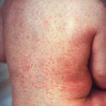 Rujeola (pojar, german measles, himlo) - Boli infectioase