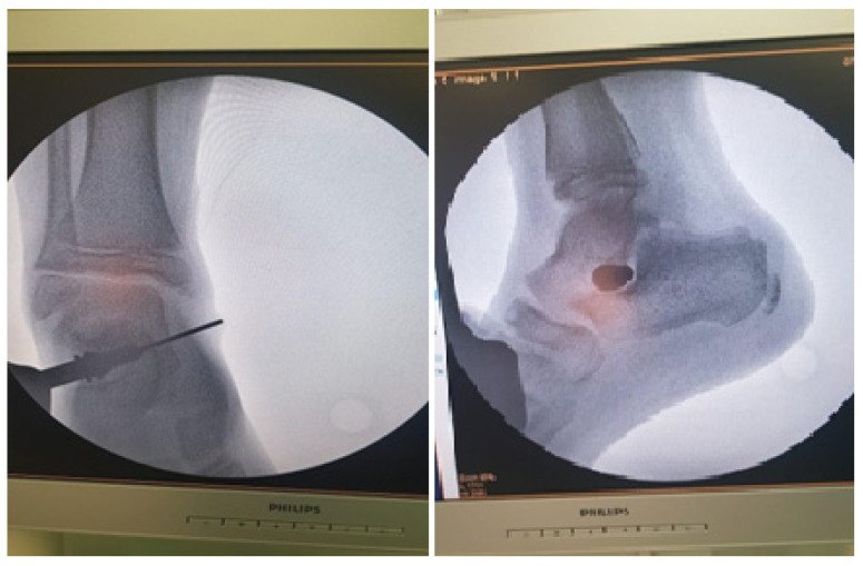 Imagini radiologice din sala de operație care confirmă poziția implantului de artroerezis în sinus tarsi