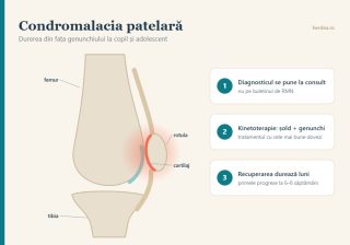 Schemă a genunchiului văzut lateral, cu rotula și cartilajul din spatele ei, în condromalacia patelară la adolescent
