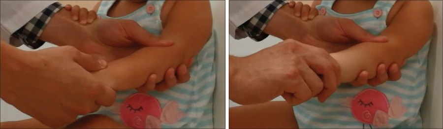 Manevra de hiperpronație Medic care efectuează manevra de hiperpronație pe cotul unui copil mic, în doi pași