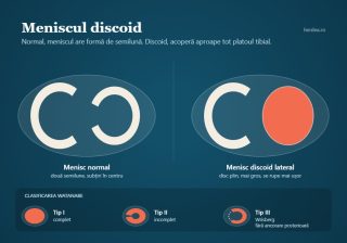 Schemă comparativă: menisc normal în formă de semilună versus menisc discoid la copil, cu cele trei tipuri Watanabe