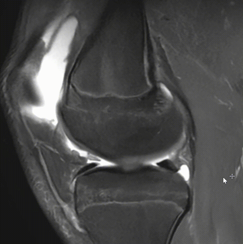 Secvență RMN sagitală de genunchi la un copil cu ruptură de ligament încrucișat anterior