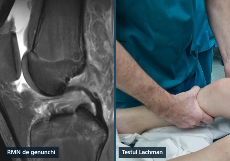RMN de genunchi cu ruptură de ligament încrucișat anterior la copil și testul Lachman