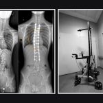 Radiografii ale coloanei unui adolescent cu scolioză severă, înainte și după tratament, alături de cadrul de mers cu sistem de tracțiune halo