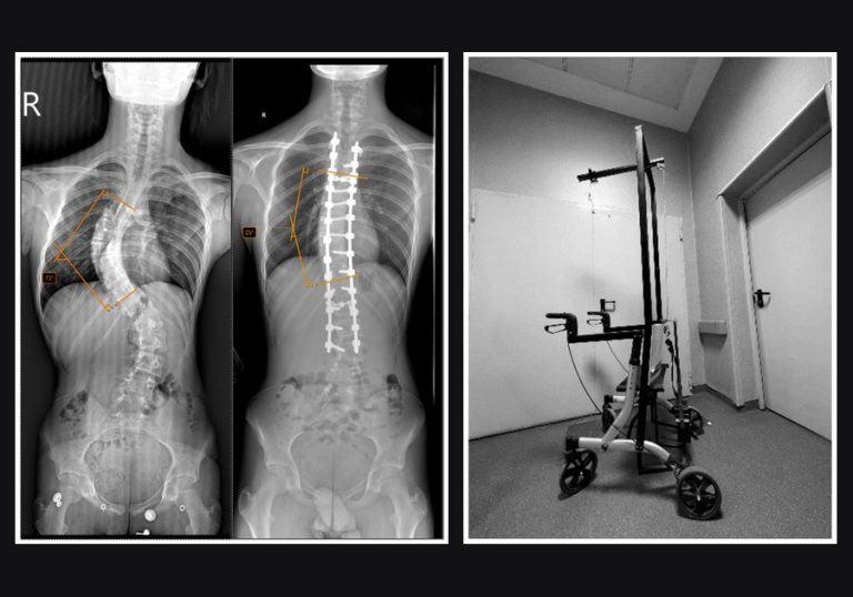 Radiografii ale coloanei unui adolescent cu scolioză severă, înainte și după tratament, alături de cadrul de mers cu sistem de tracțiune halo