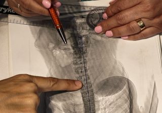 Radiografie de coloană pe care se măsoară unghiul Cobb, cu rigla și goniometrul așezate pe film