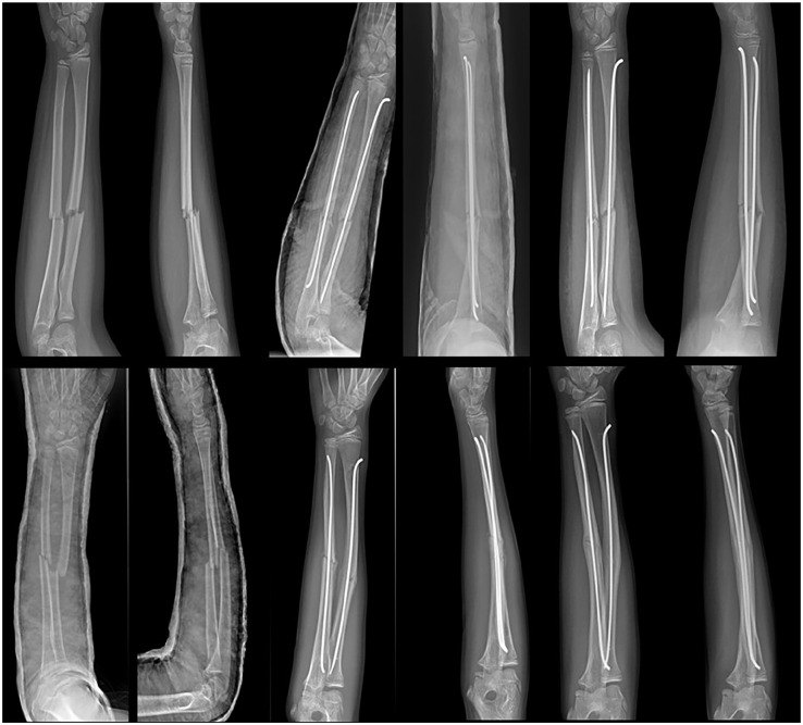 Radiografii ale antebrațului la copii operați cu tije elastice, în mai multe etape ale vindecării fracturii